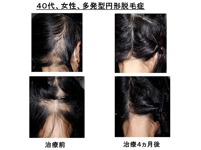 円形脱毛症　病院